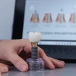 Implanty zębów. Kiedy warto je rozważyć i jak przygotować organizm?