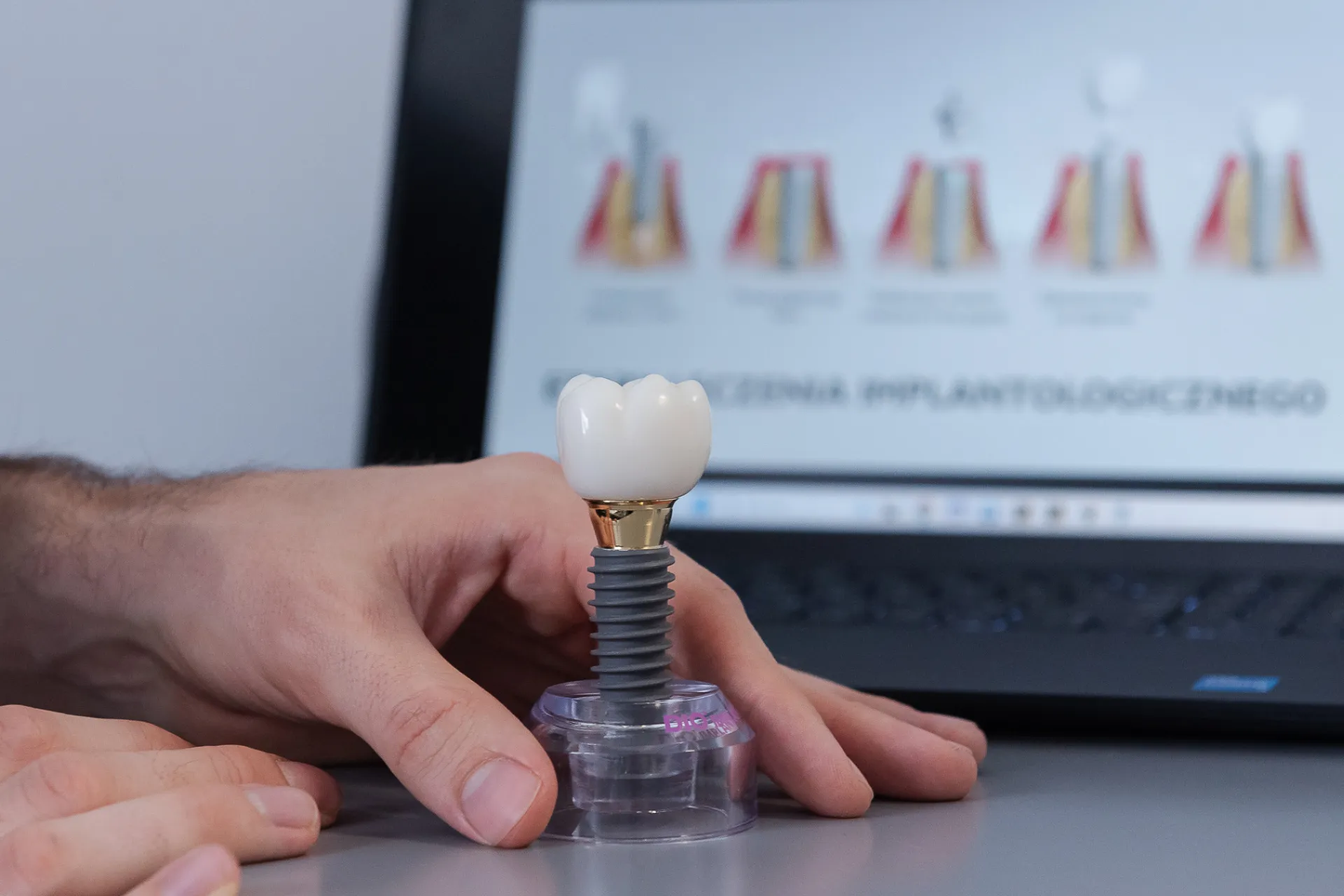 Implanty zębów. Kiedy warto je rozważyć i jak przygotować organizm?